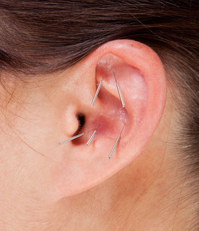 Ohrakupunktur Nach Dr. P. Nogier